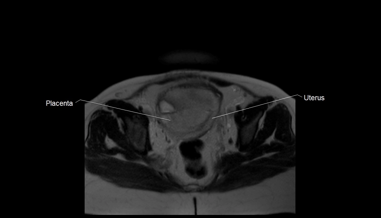 MRI fetal anatomy axial image 35.webp